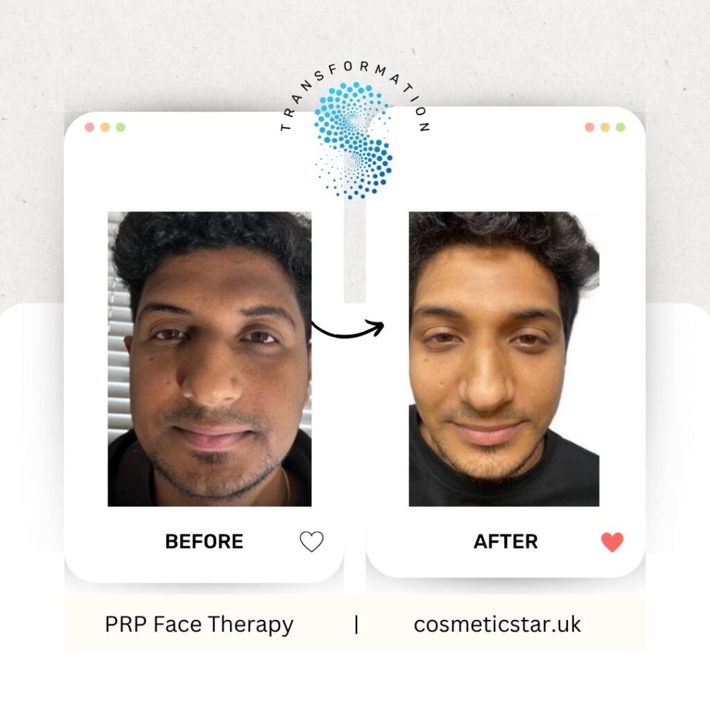 PRP for face
