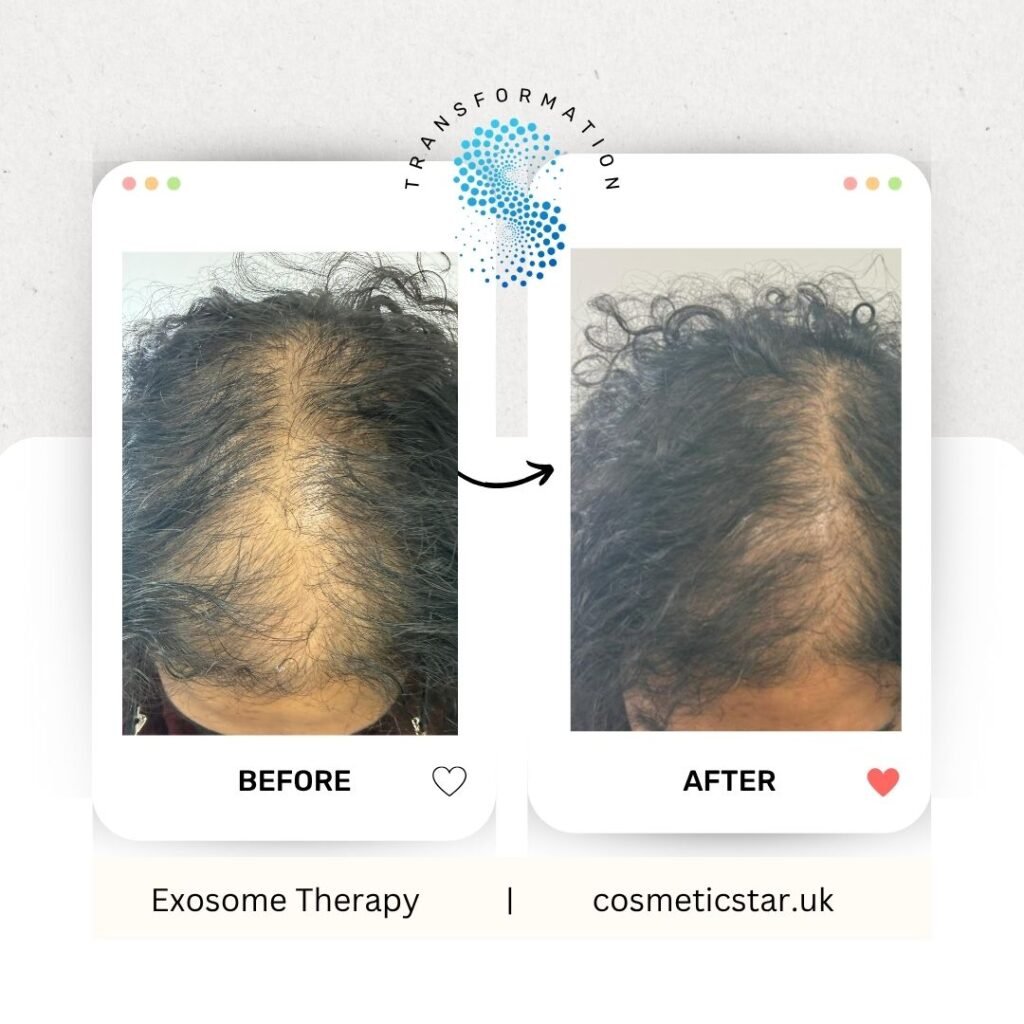 exosome therapy in leeds